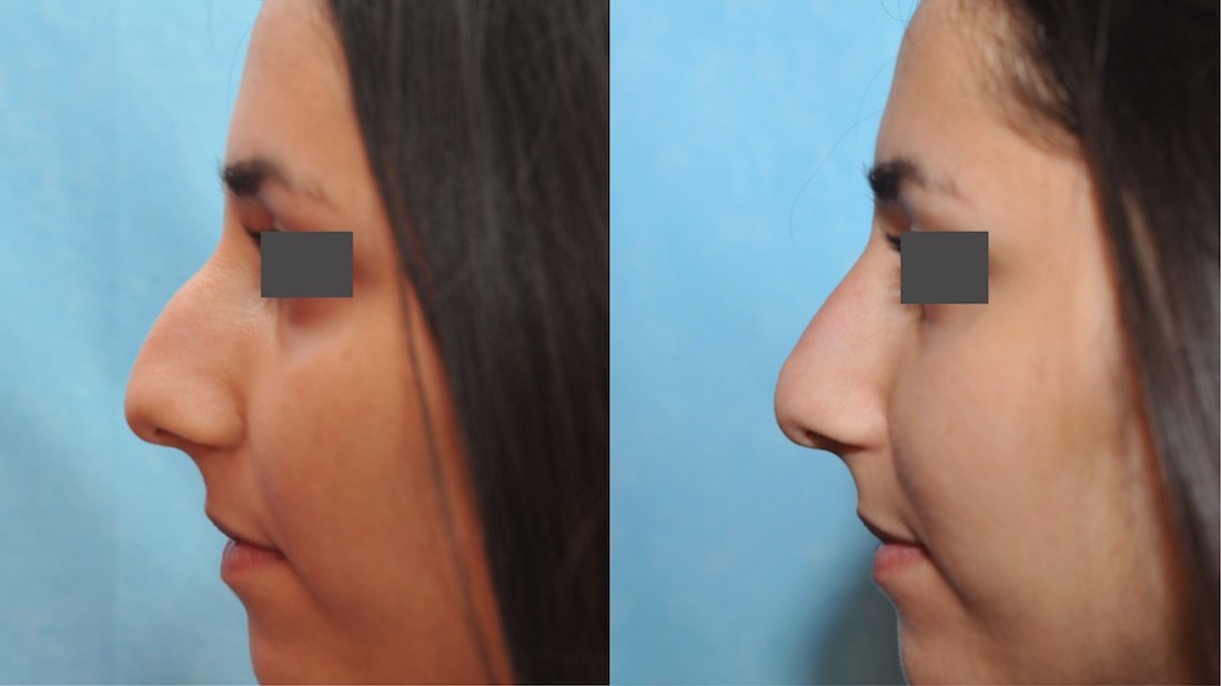 rhinoplastie médicale